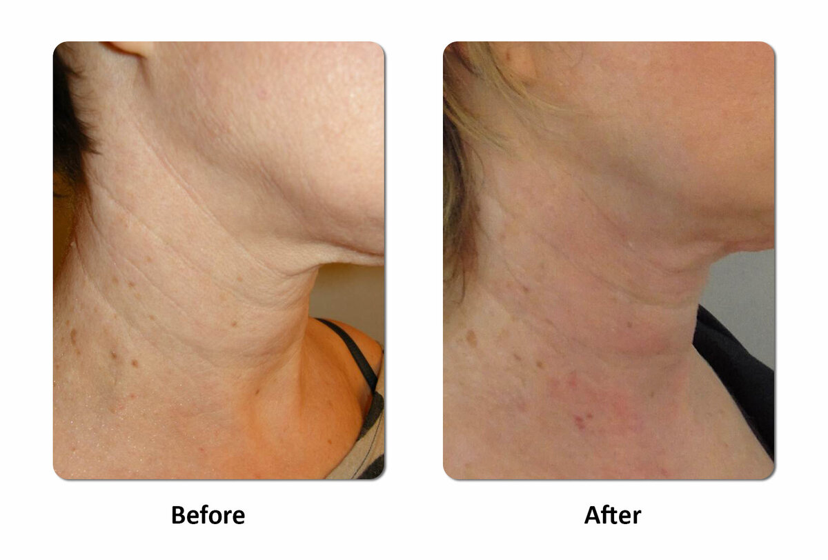Li Medical Aesthetics Skin Tightening with VST Sinclair Before and After6