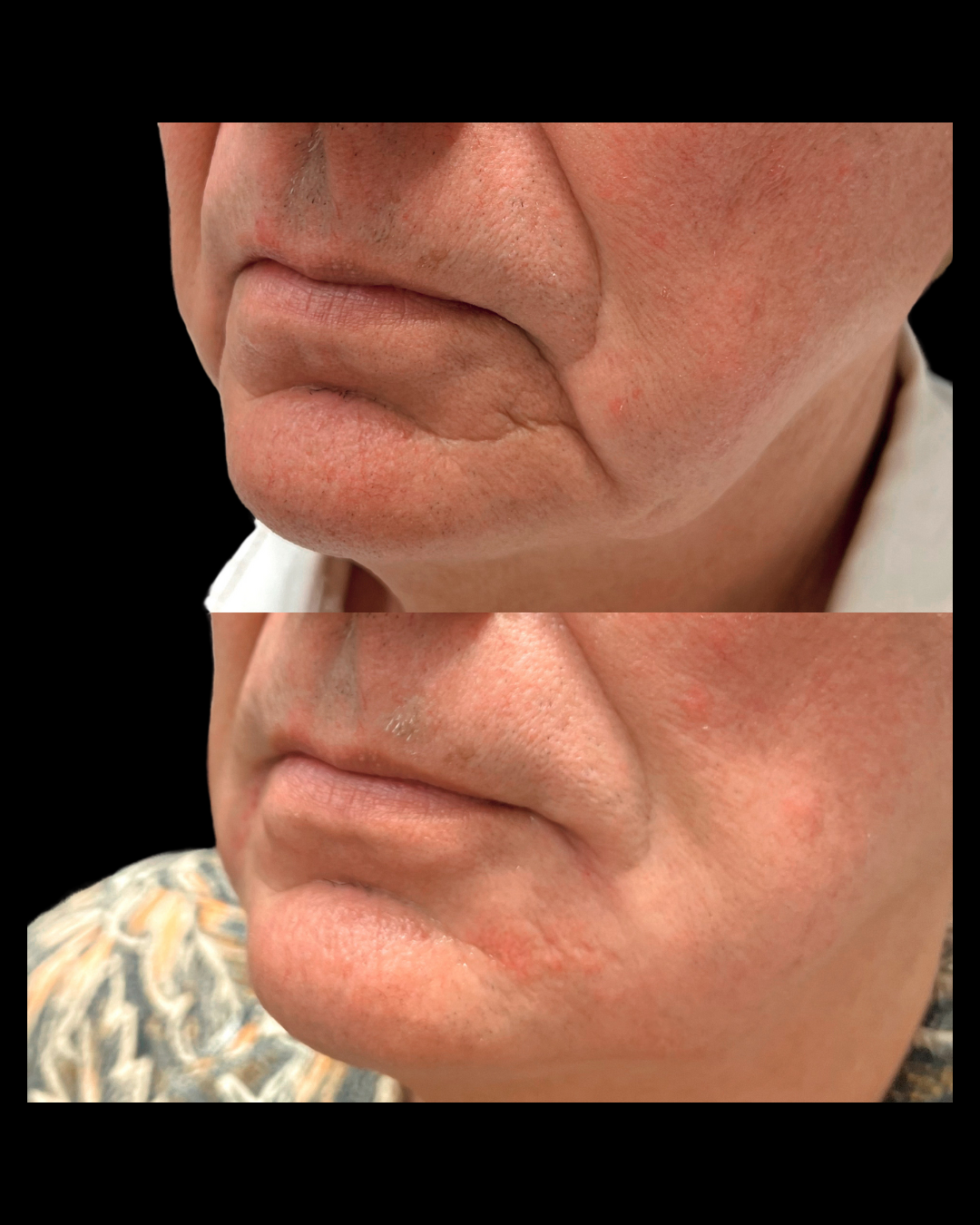 Lower face before and after showcasing Sculptra or dermal filler treatment to restore lost volume and smooth deep lines