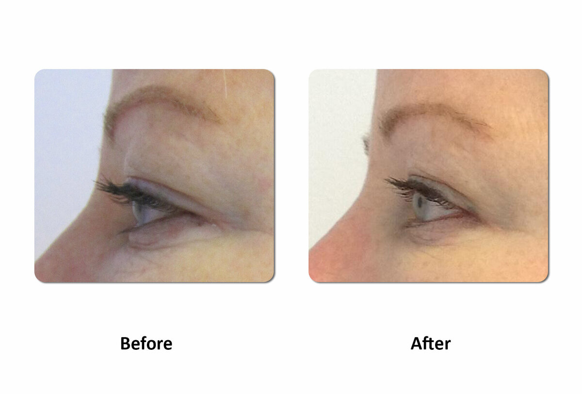 Li Medical Aesthetics Skin Tightening with VST Sinclair Before and After4