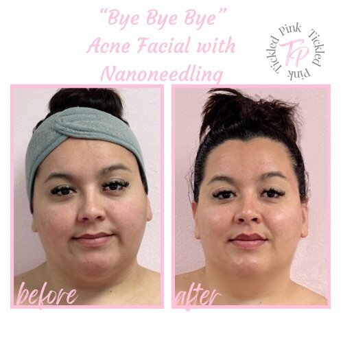 tickled pink aesthetics facial before and after