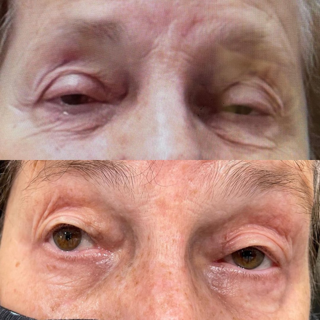Ptosis surgery(1)