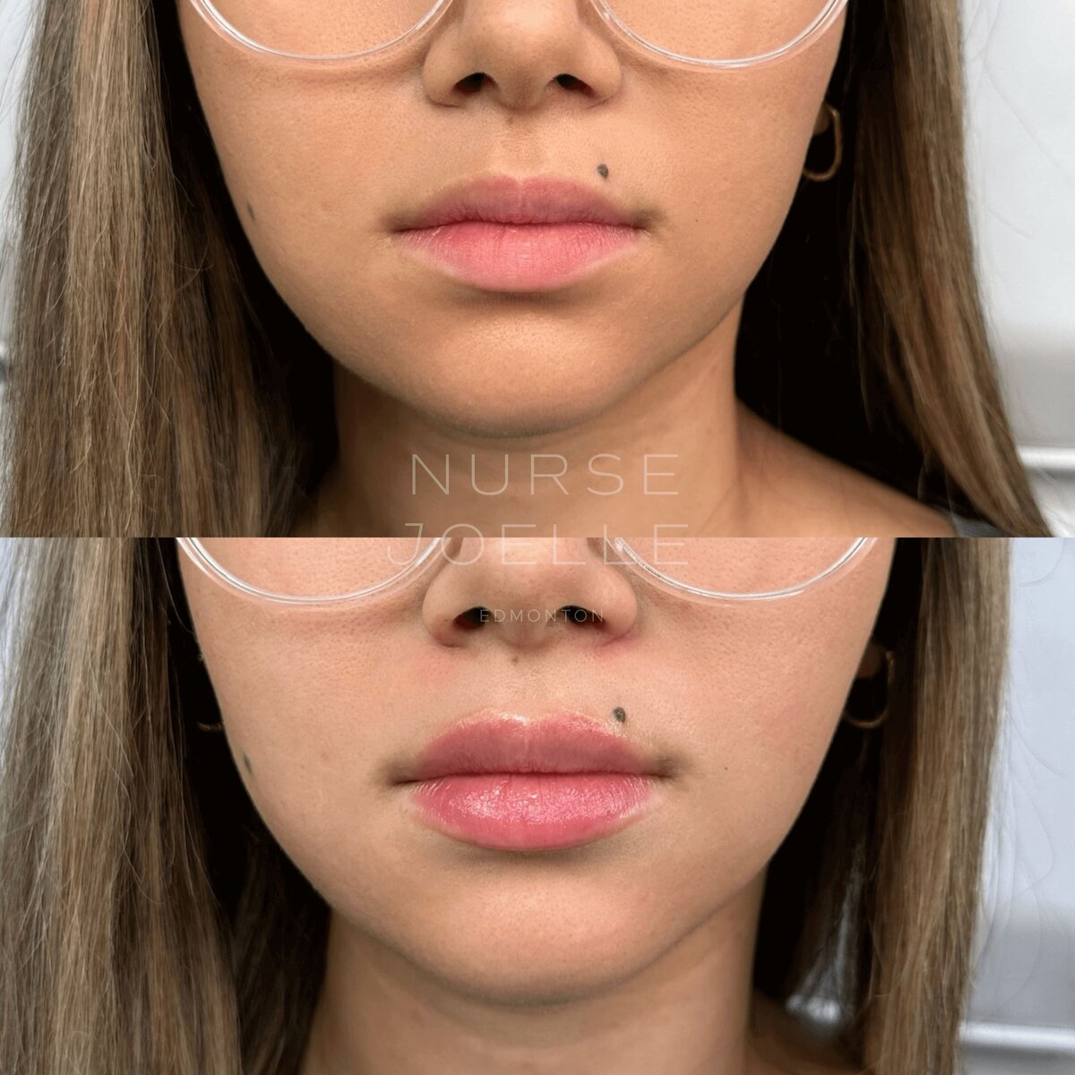 Nurse-Joelle-Cosmetic-Injectables-Before-and-After-20