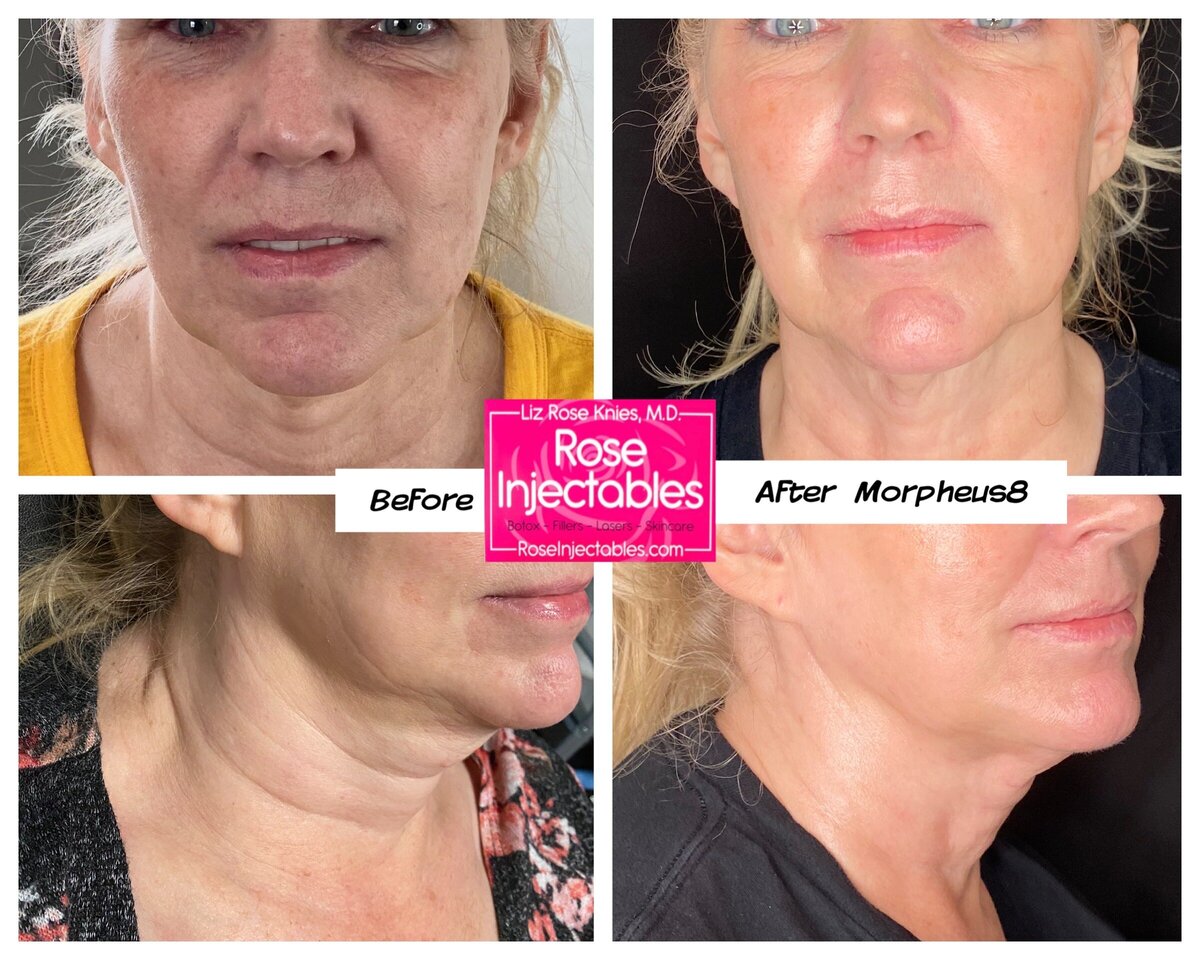 Morpheus8-by-Rose-Injectables-Before-and-After-Photos-22