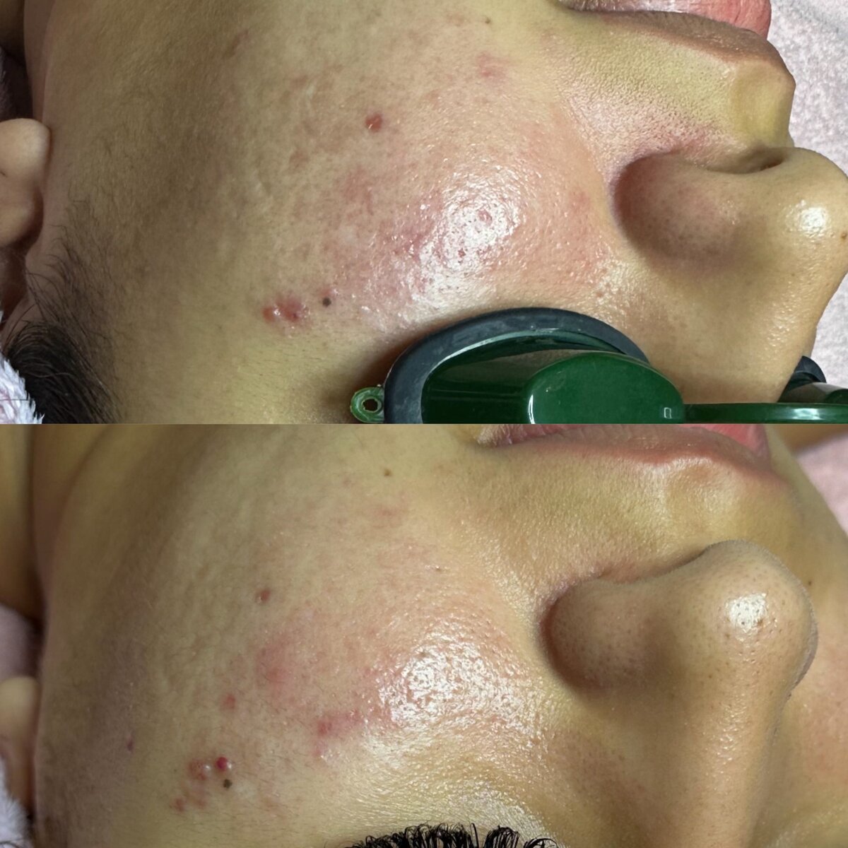 Cheek Acne B&A