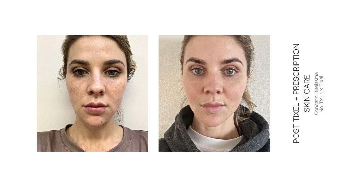 Melasma Before and After 2