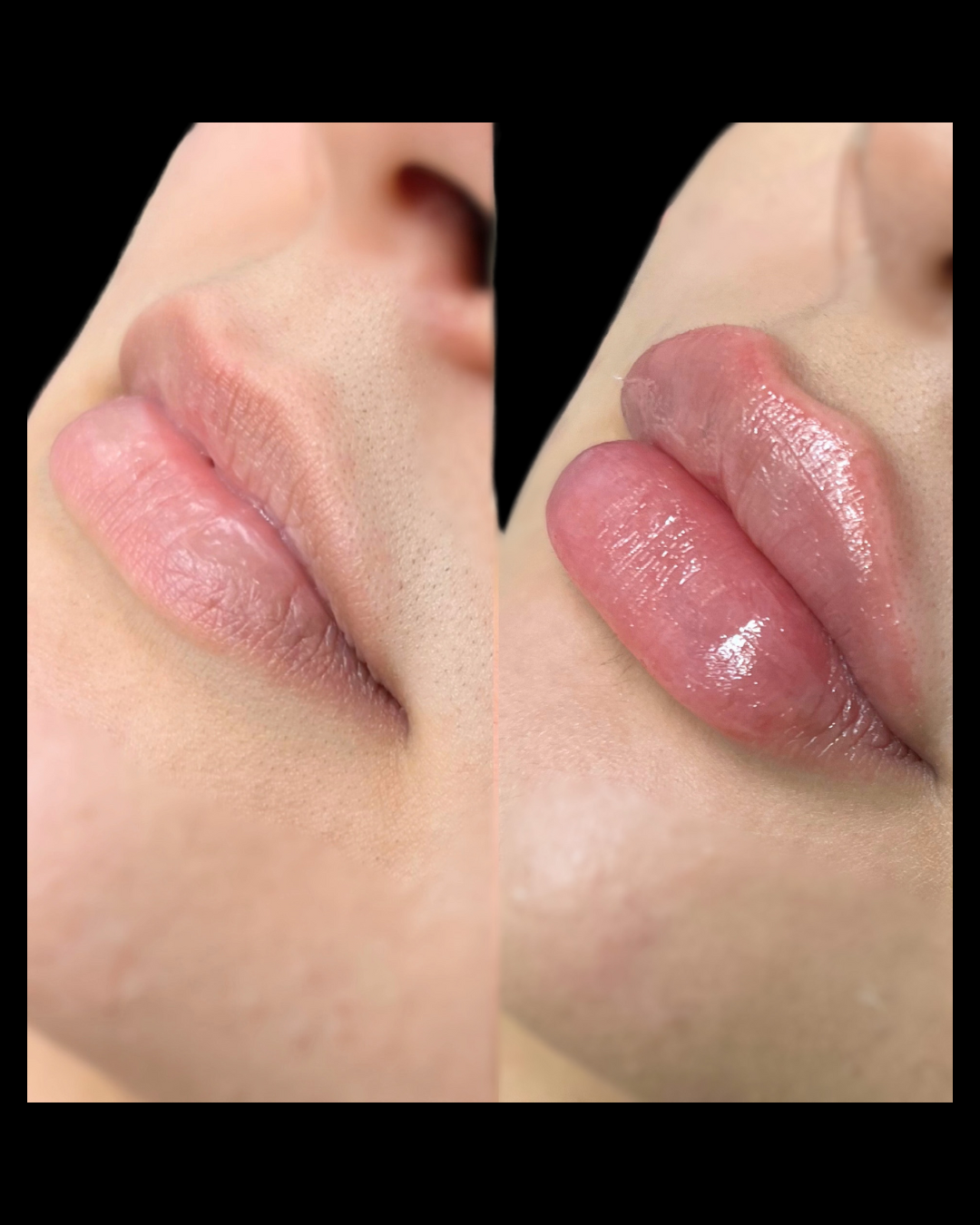 Close-up before and after of lip filler enhancement, improving shape and volume