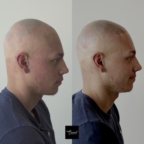 Alex-alopecia-copy-3