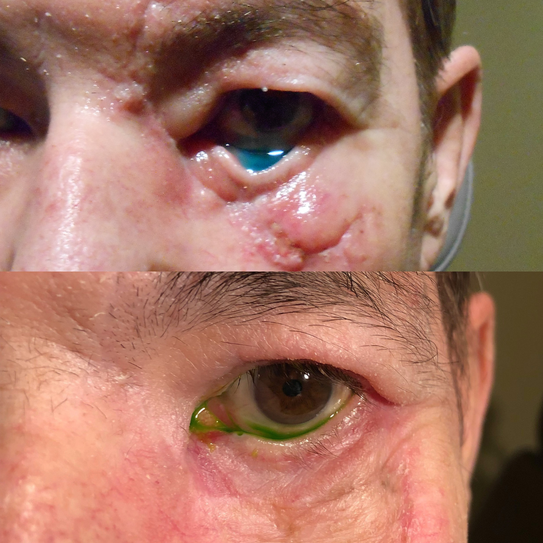 Eyelid reconstruction with skin graft