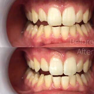 34_before-after-14-bonded20filling20on20a20chipped20upper20front20tooth.JPEG