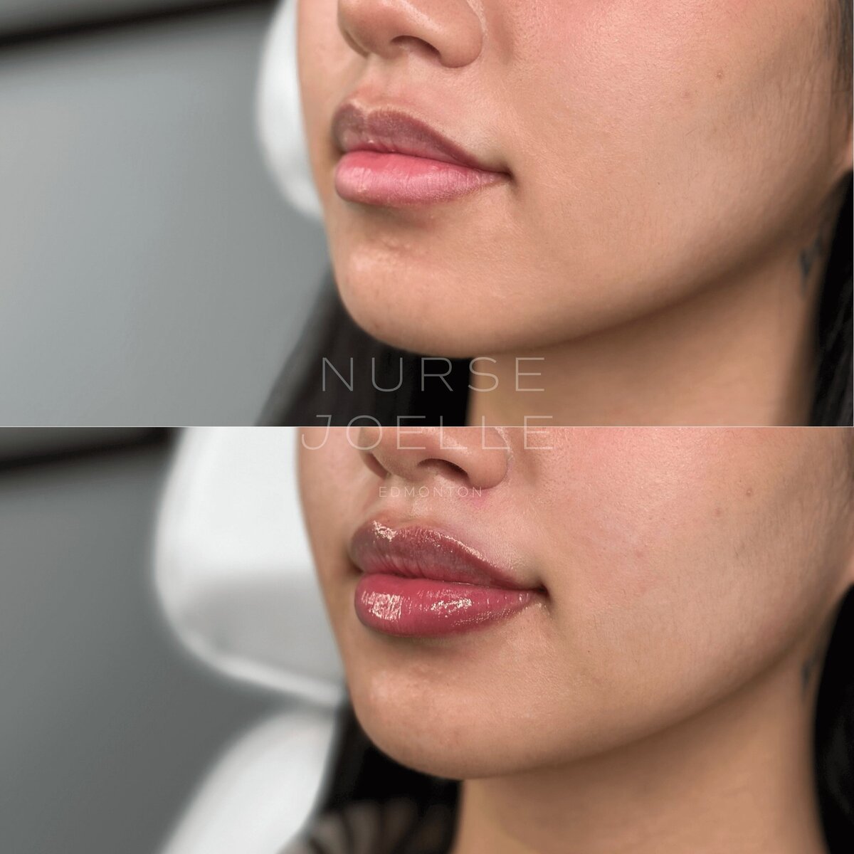 Nurse-Joelle-Cosmetic-Injectables-Before-and-After-5