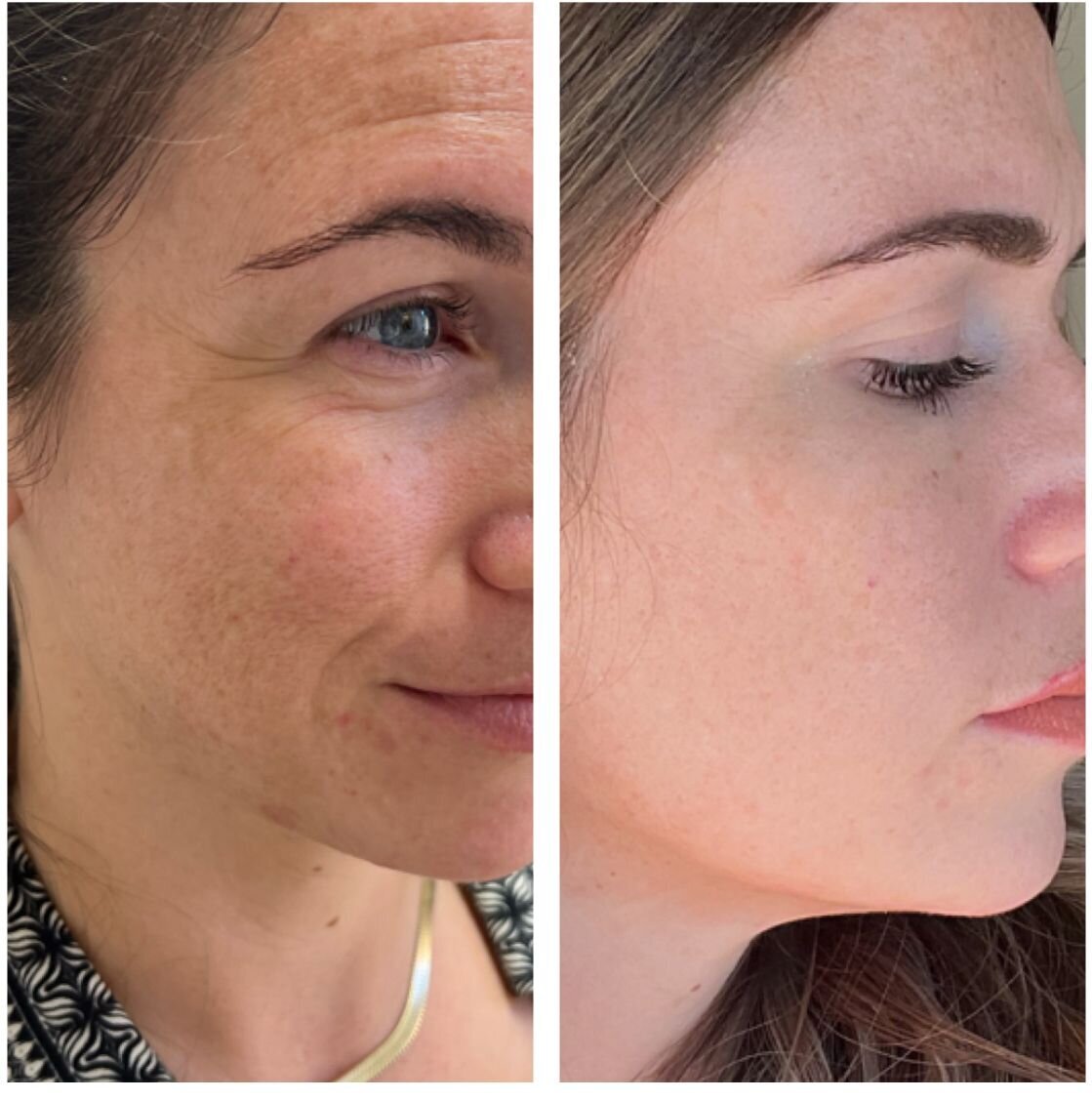 compressed-Chemical-Peels-brand-pics-and-b-a-05