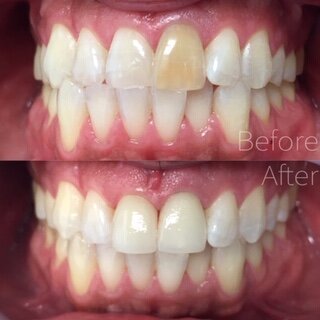 20crowns20on20two20upper20front20teeth20to20even20shade20and20alignment.JPEG