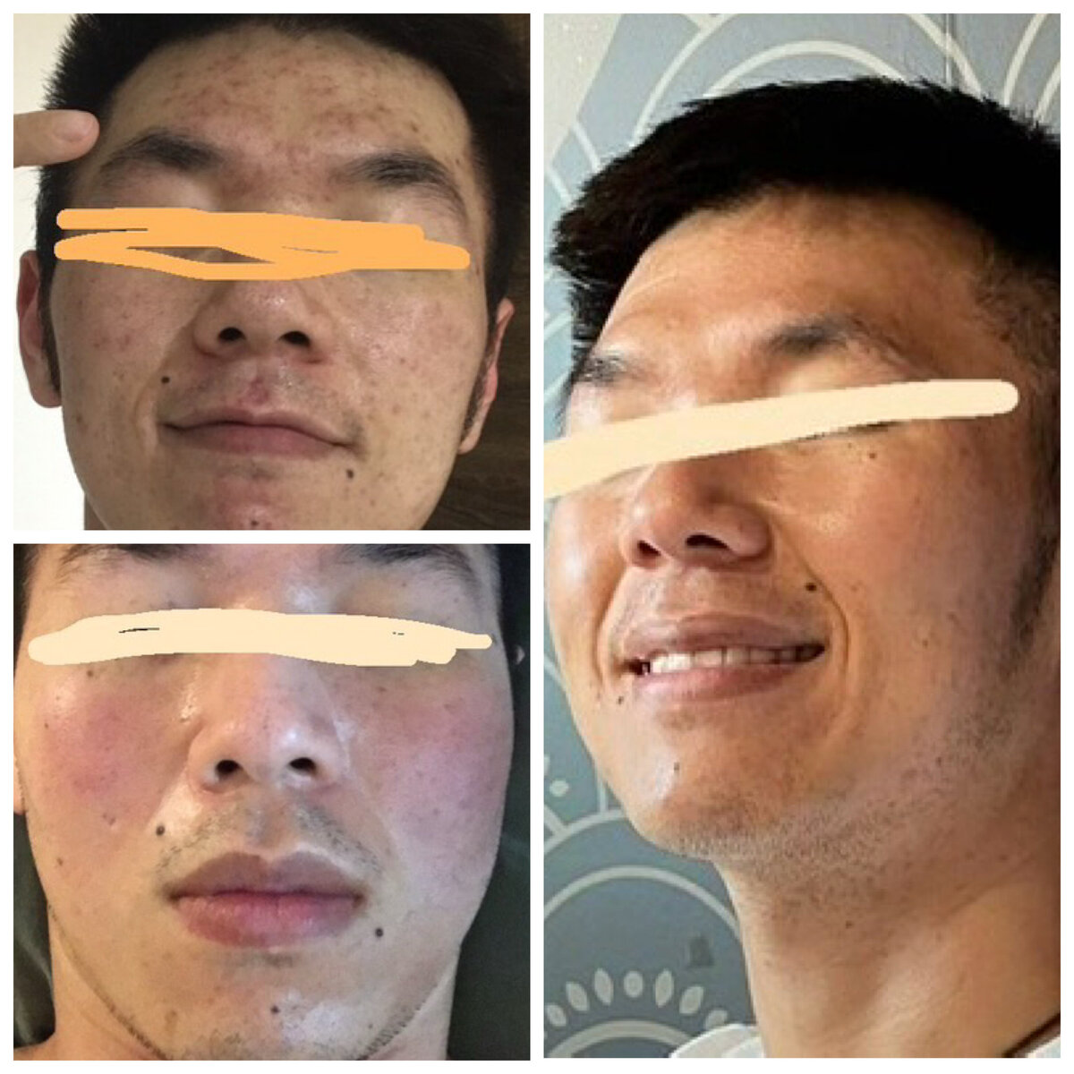 Smiling confidently after transforming rosacea-prone skin to clear and radiant with The Rosacea Method.