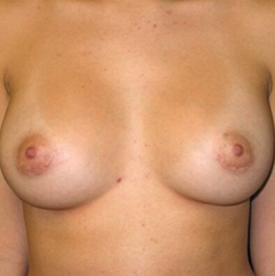 after_breast 9