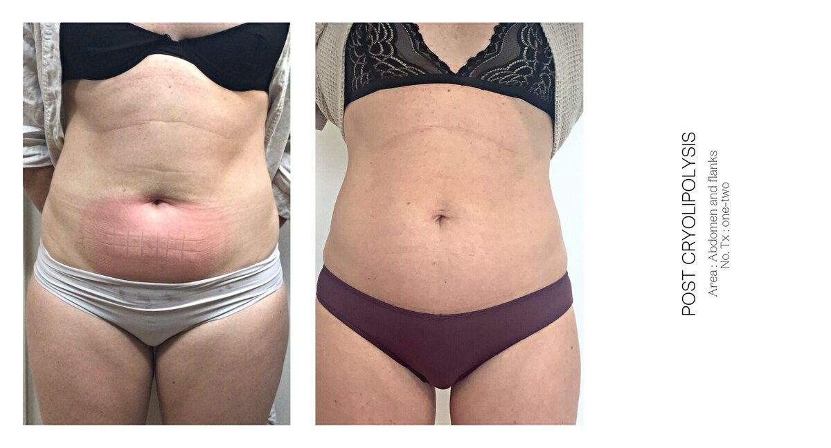 Cryolipolysis Muffin Tops Before and After 1