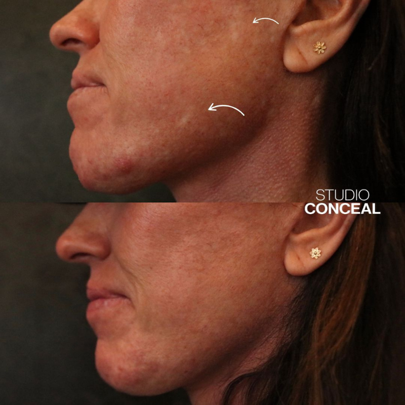  acne scar revision tattoo