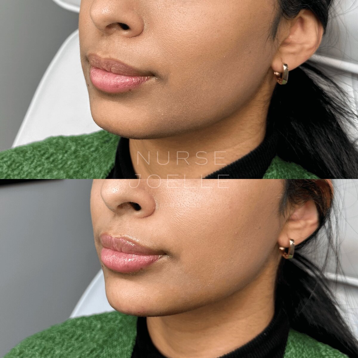 Nurse-Joelle-Cosmetic-Injectables-Before-and-After-19