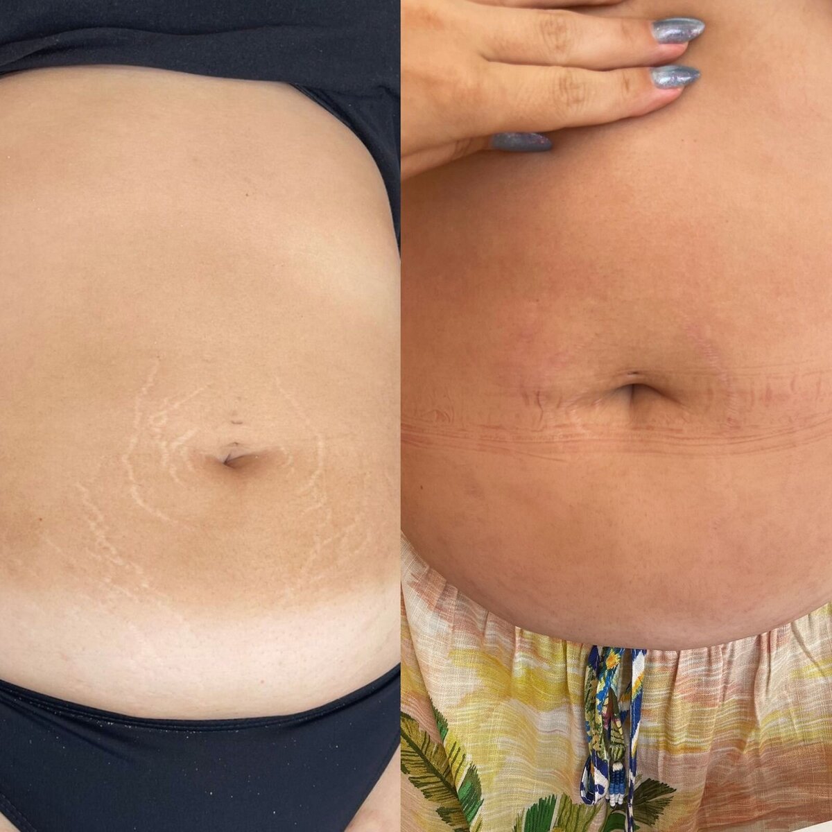 estria stretch mark Bianca 01