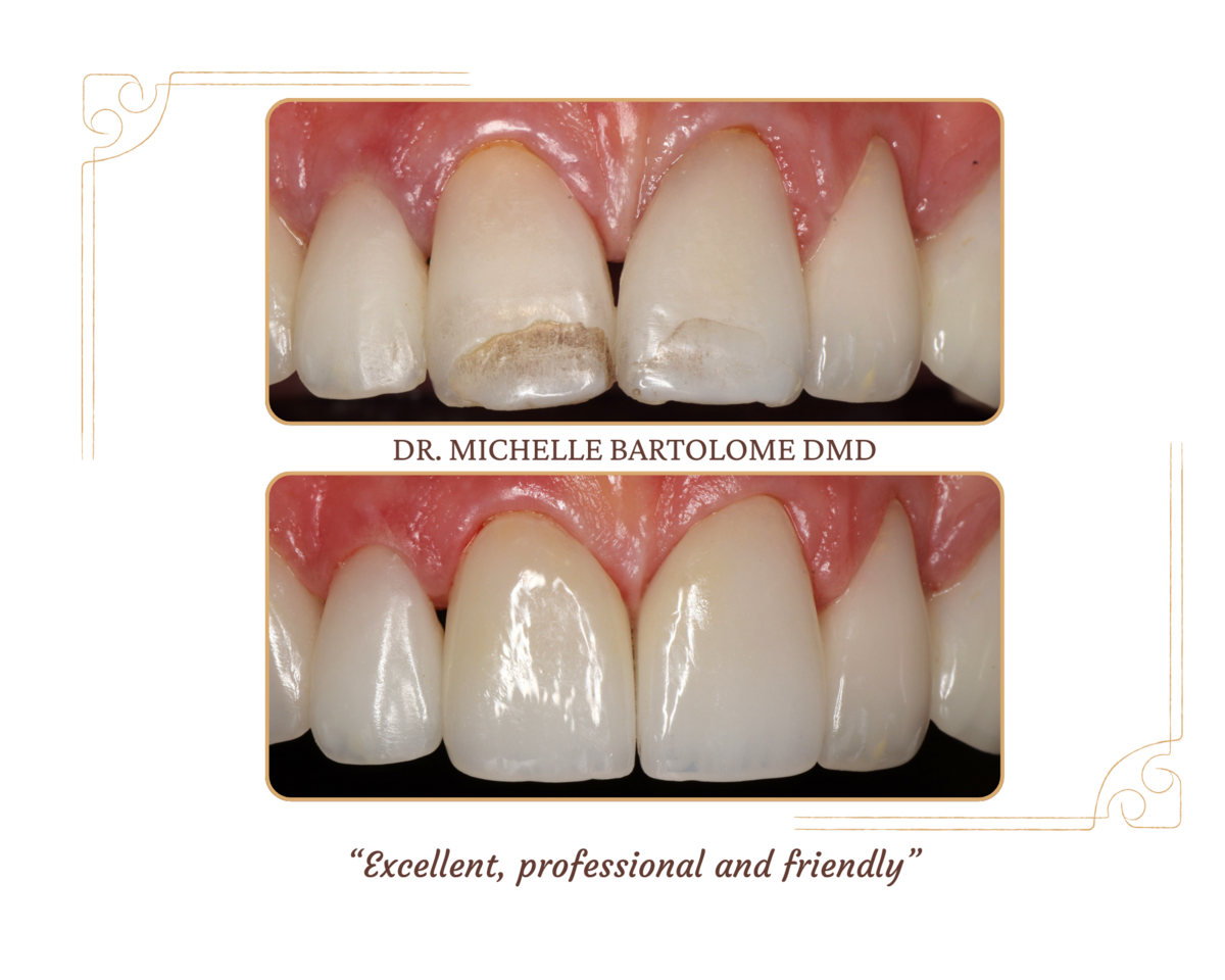 Single Crowns