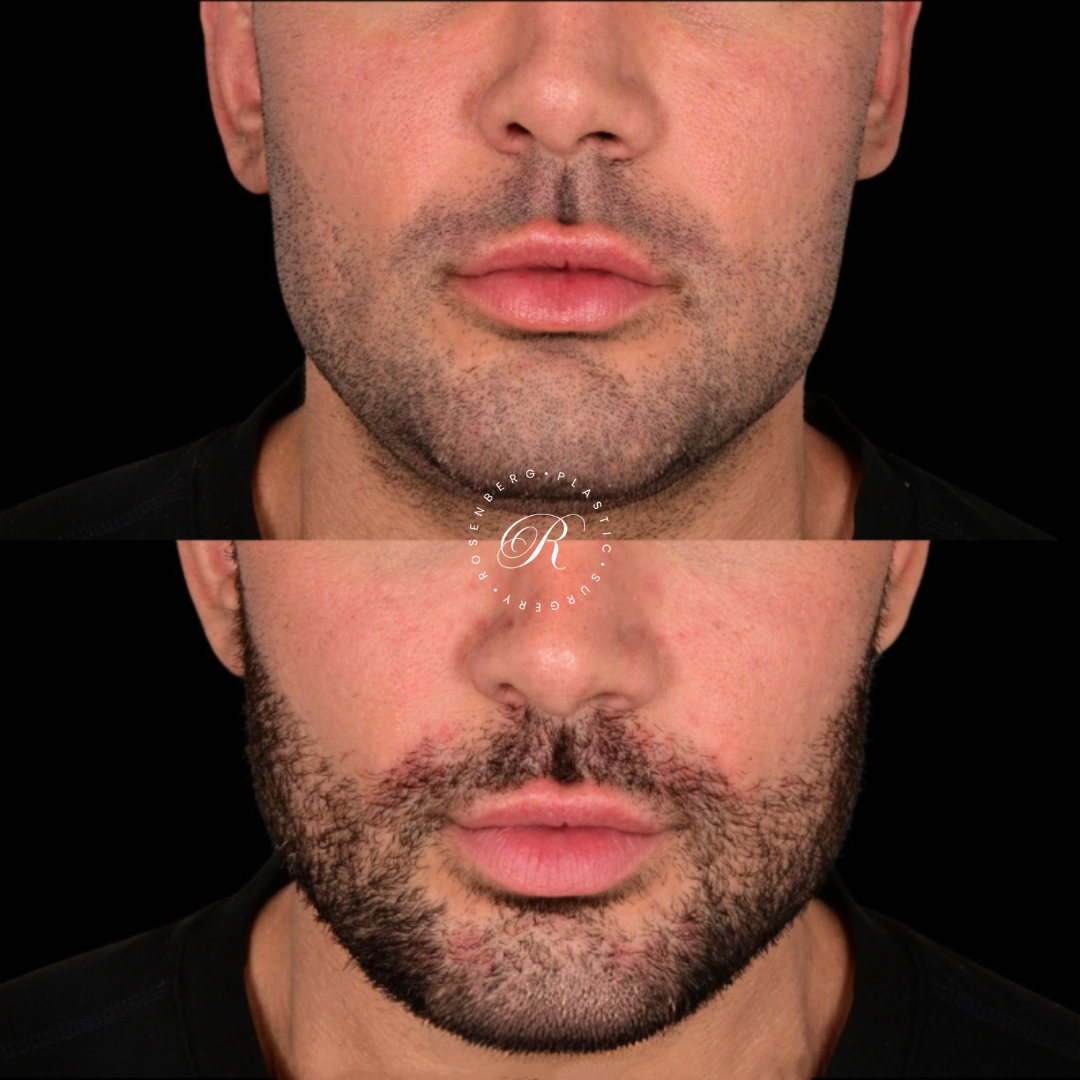 Neck Lipo RPS Before & After.zip - 34