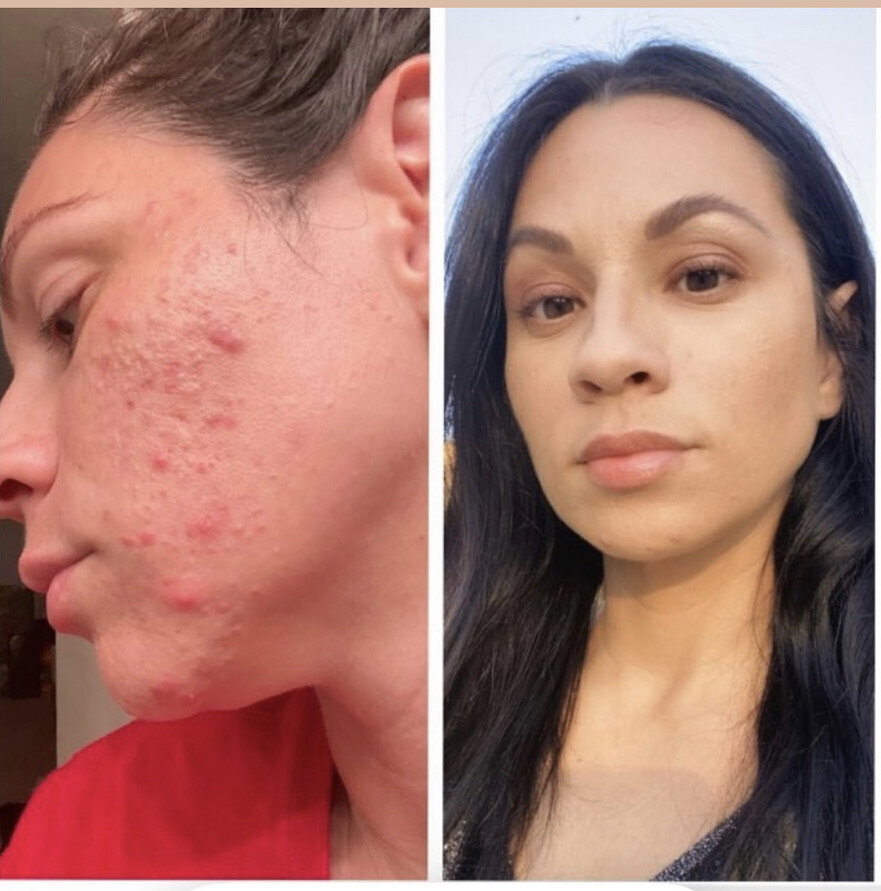 Acne correction specialist