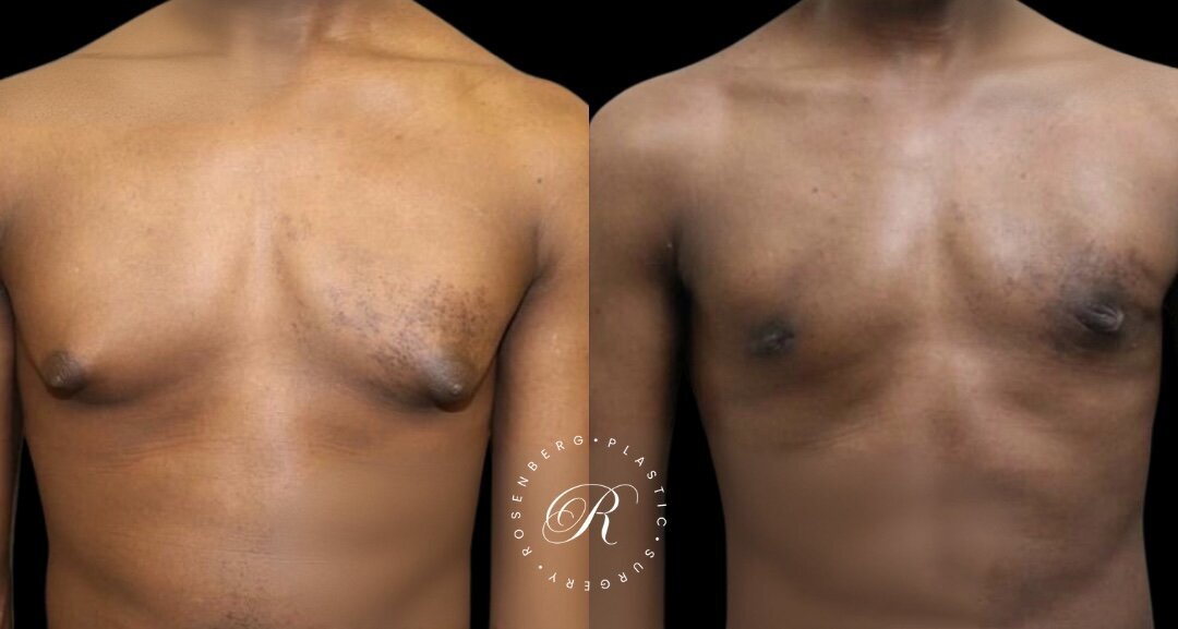 Gynecomastia RPS Before & Afters.zip - 10