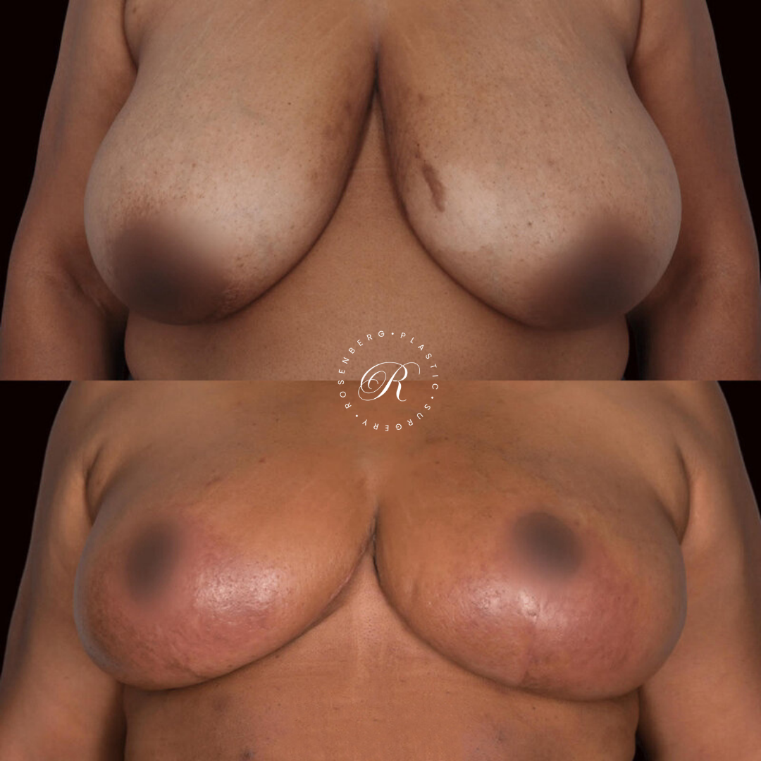 Breast Lift & Reduction RPS Before & Afters.zip - 17