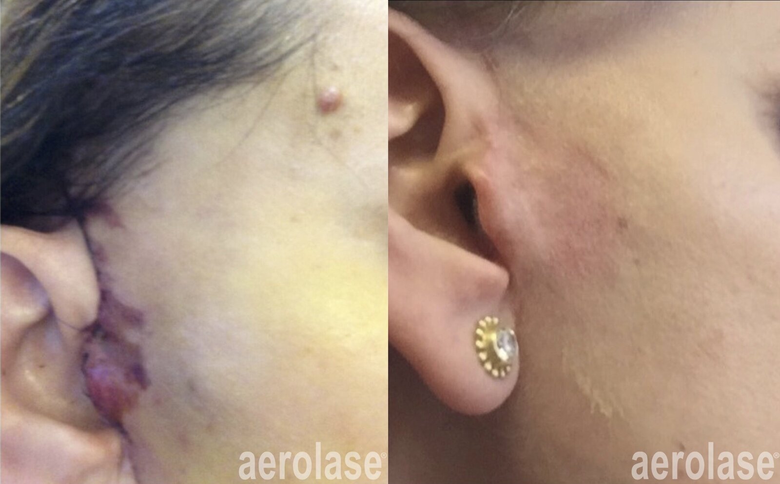 Post-Surgical Scars - Elena Ginsberg, NP