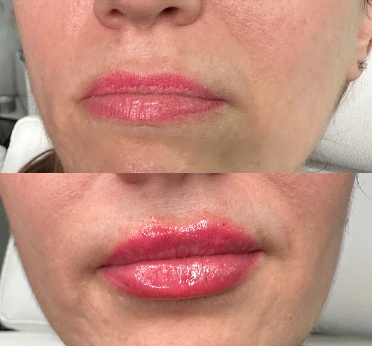 W Aesthetics Dermal Fillers Before and After. Austin Texas 6