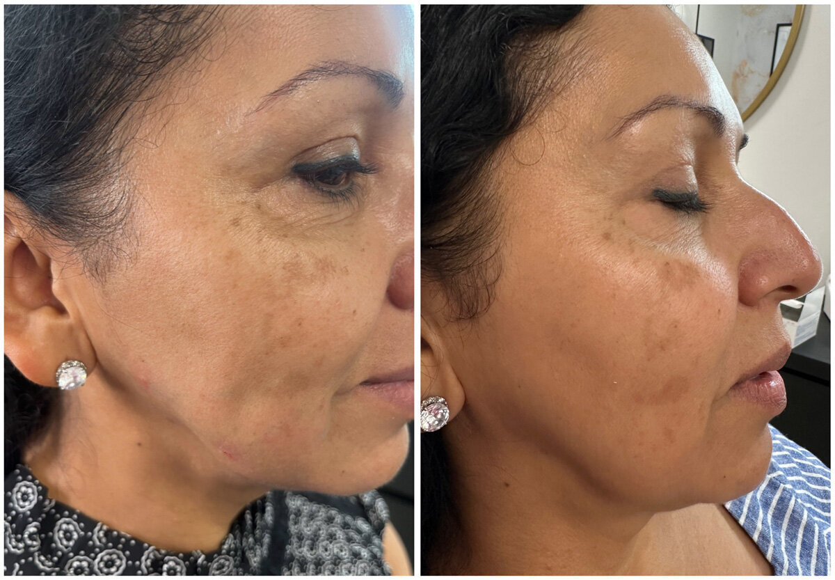 W Aesthetics Dermal Fillers Before and After. Austin Texas 1