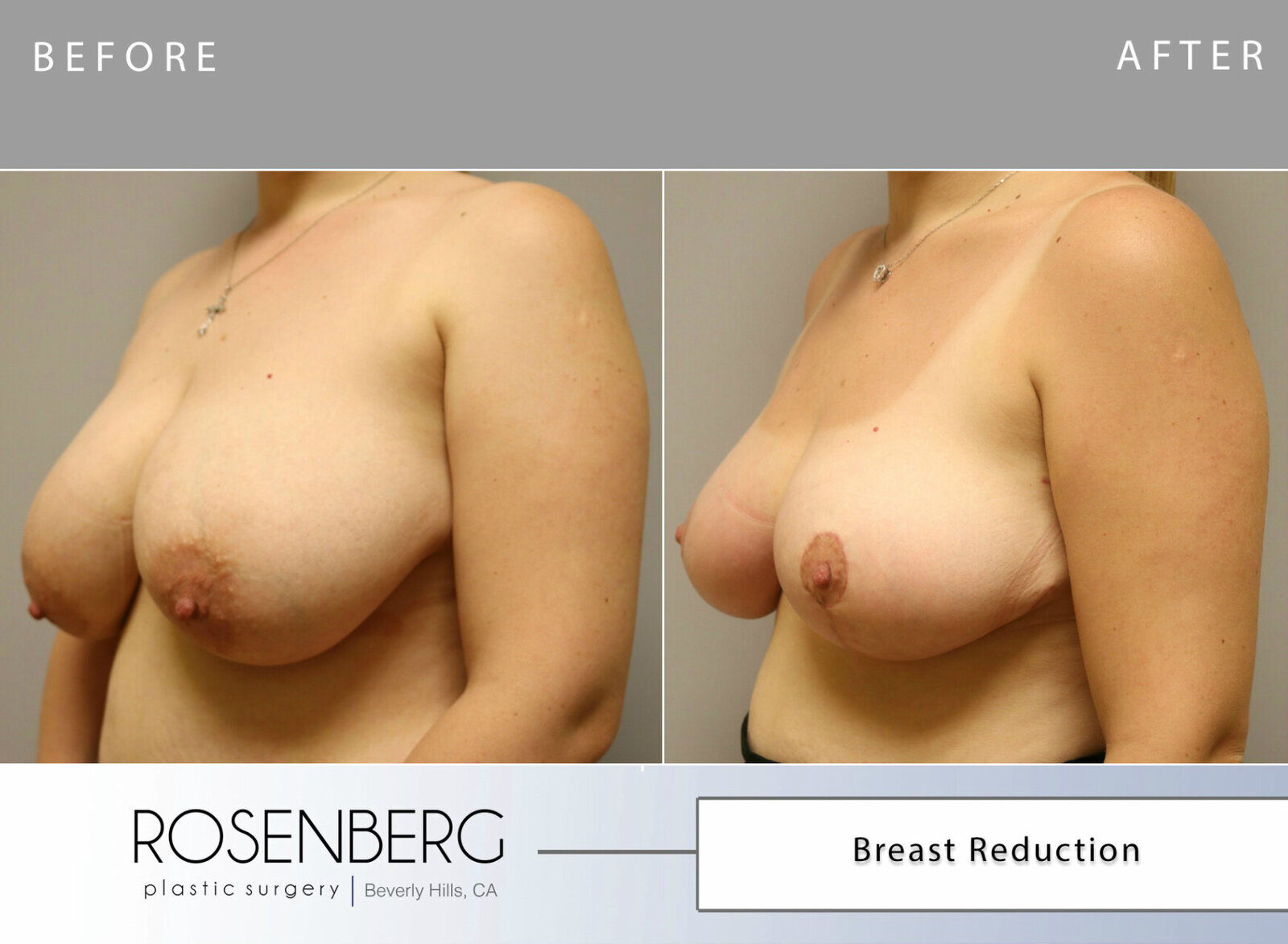 Dianna Endzhighoulian Before and after Breast Reduction 