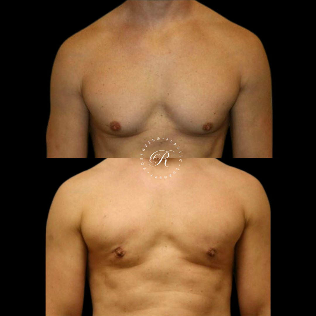 Gynecomastia RPS Before & Afters.zip - 3