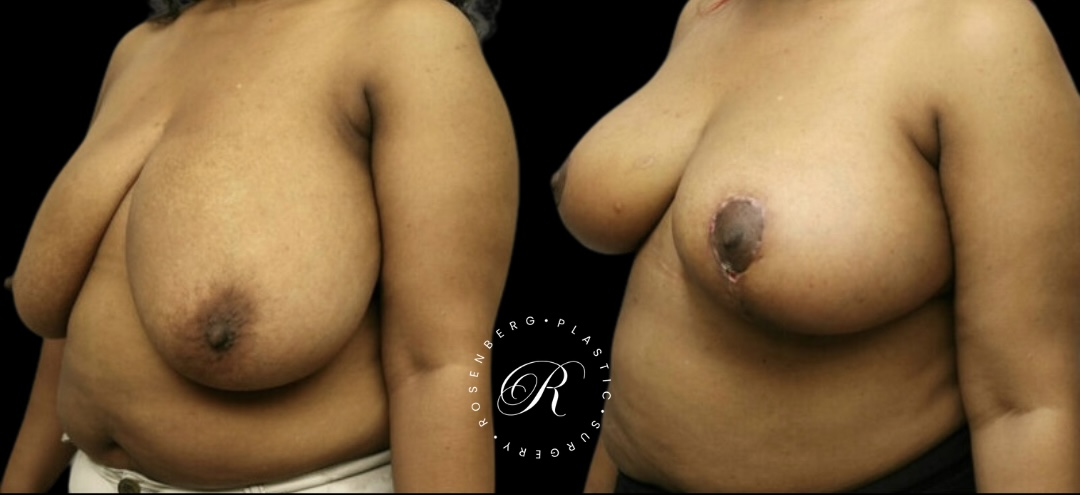 Breast Lift & Reduction RPS Before & Afters.png