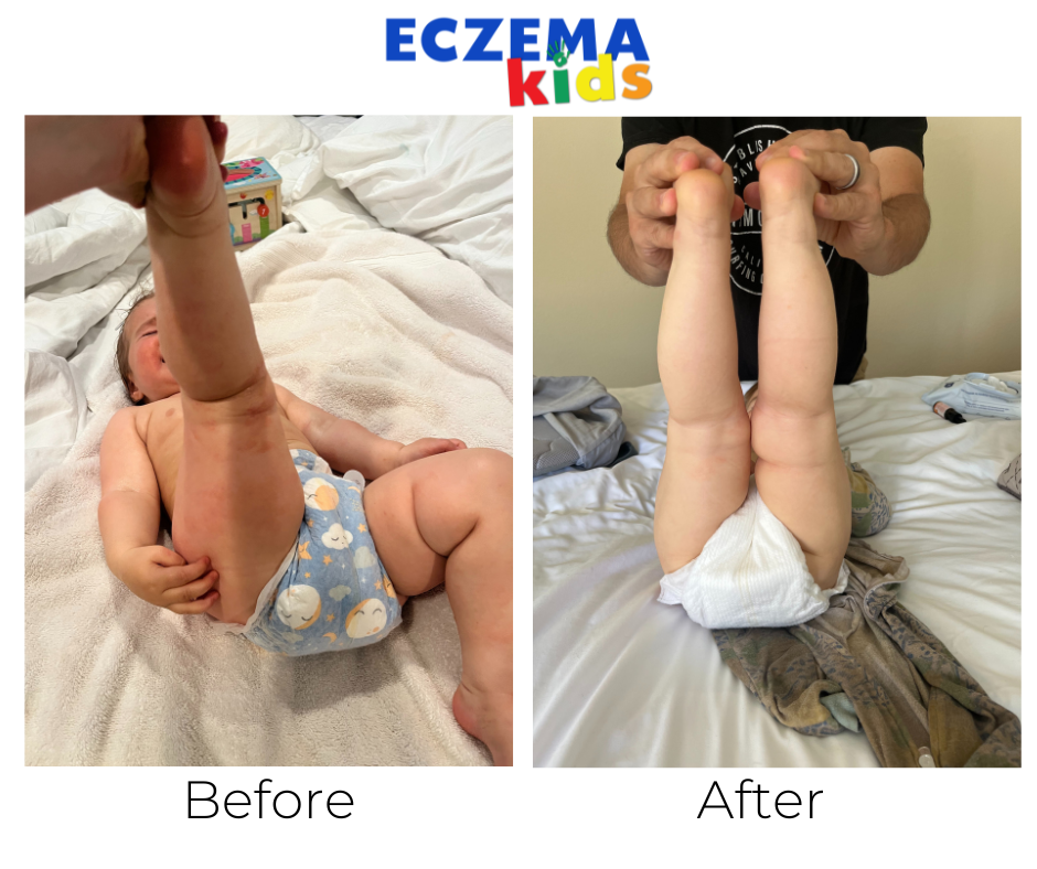 Eczema healing Eloise