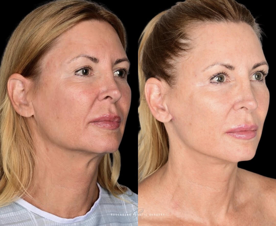 Face Lift Results