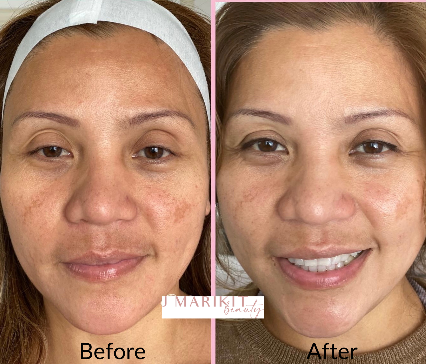 Image of results from customer that received the island of Oahu's top derma-therapy services.