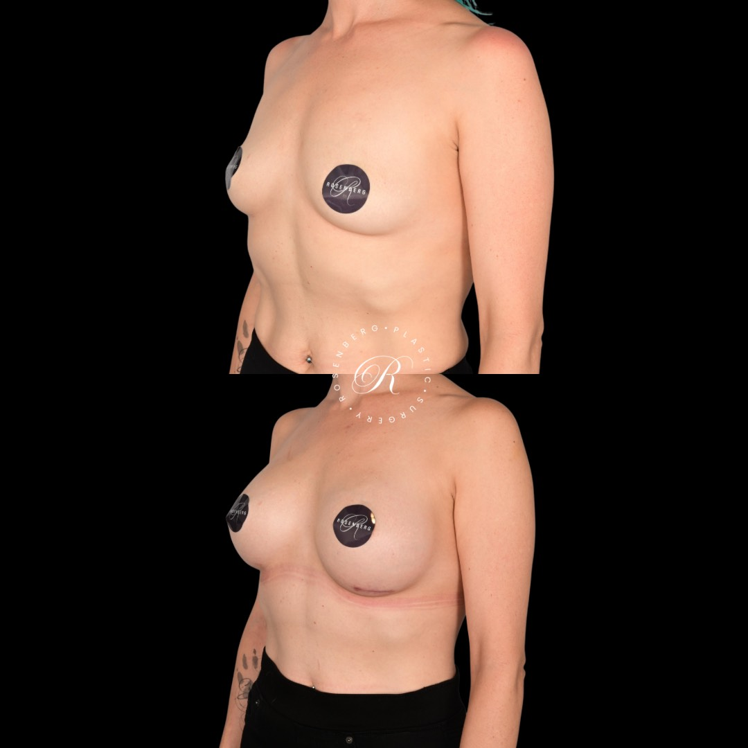 Breast Augmentation Before and After