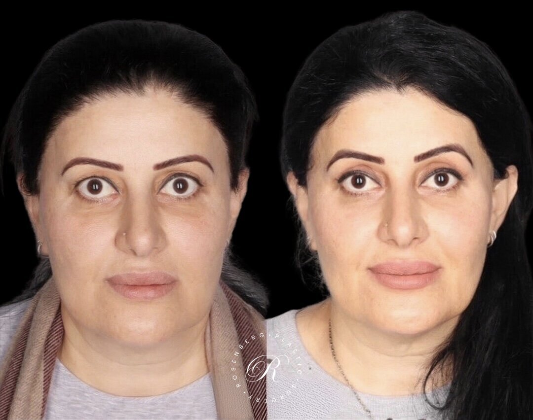 Blepharoplasty RPS Before & After.zip - 8