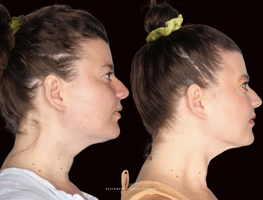 Neck Liposuction Results