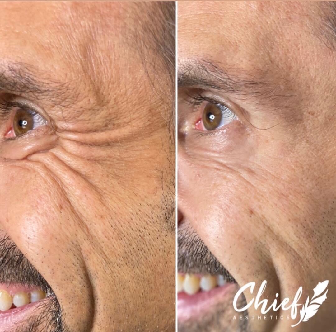 Men’s-Botox-crows-feet-buffalo-ny-chief-aesthetics