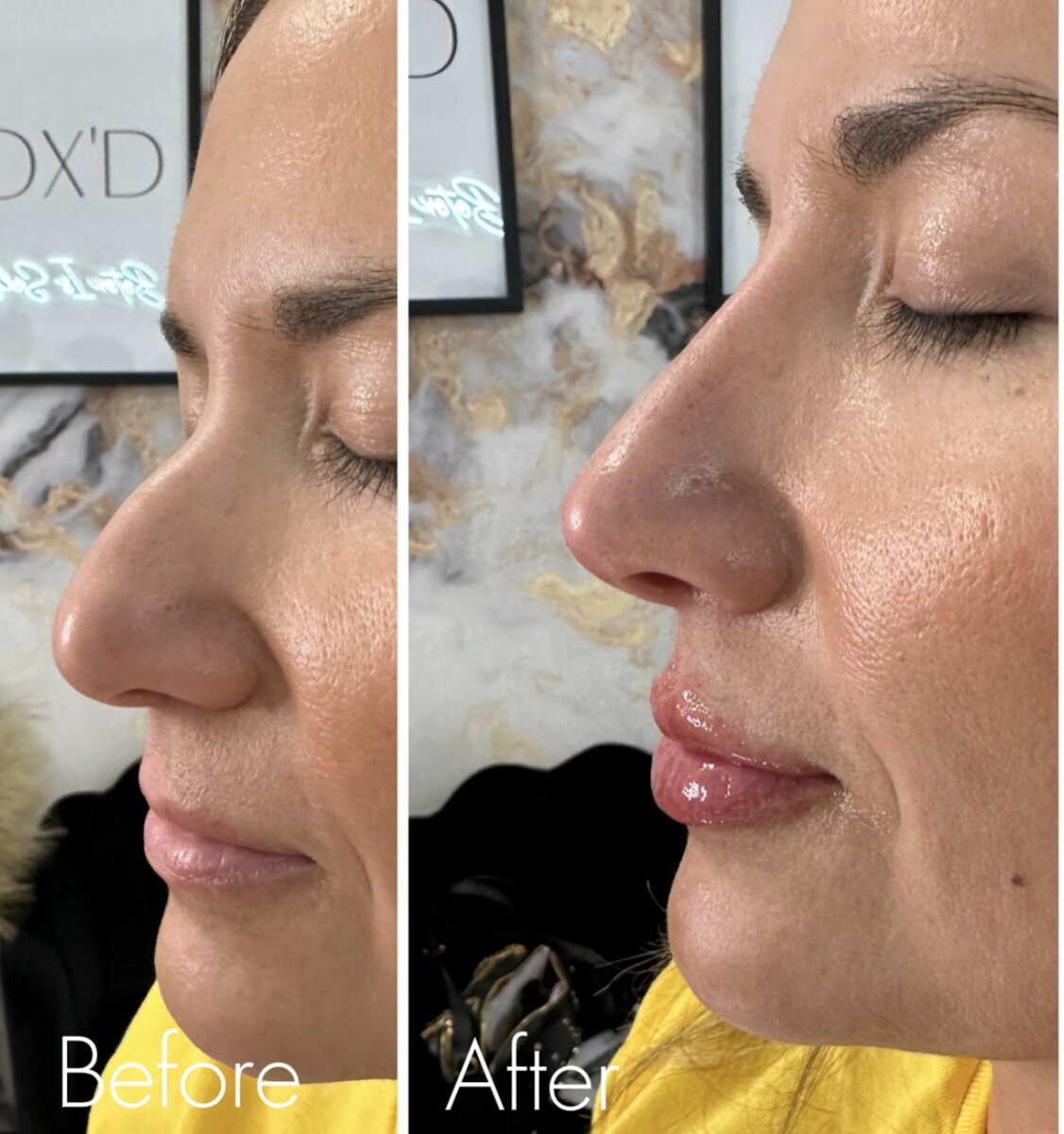 W Aesthetics Non Surgical Rinoplasty  Before and After Austin Texas3
