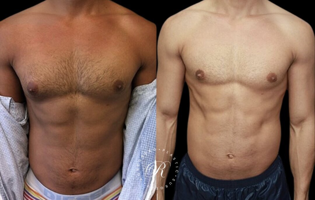 Gynecomastia RPS Before & Afters.zip - 4