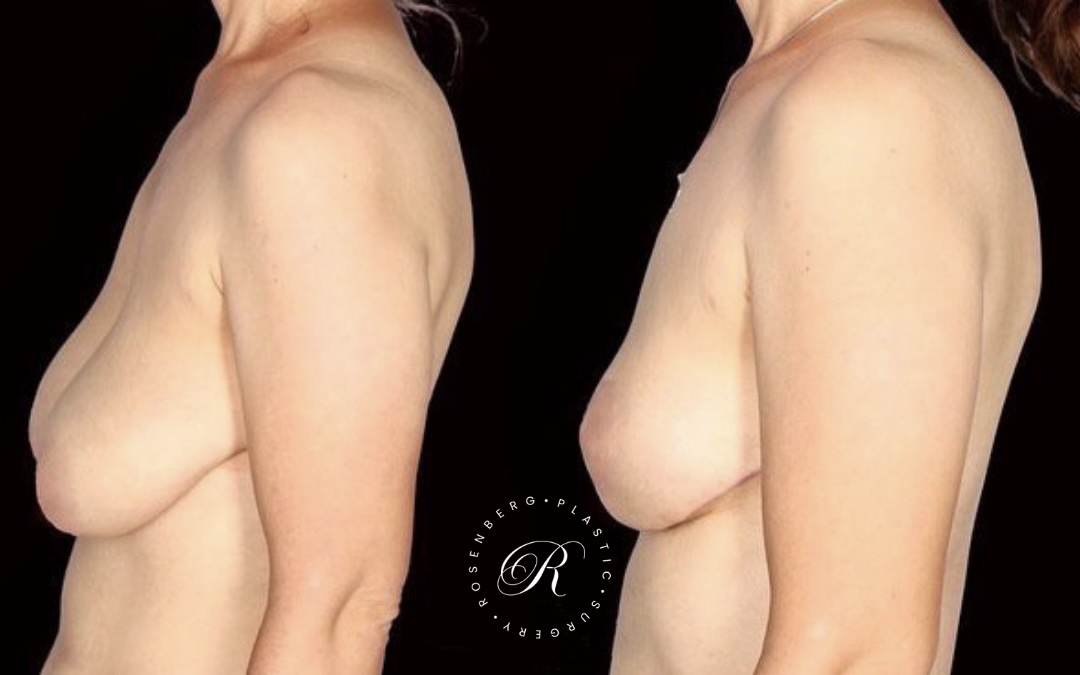 Breast Lift & Reduction RPS Before & Afters.zip - 84