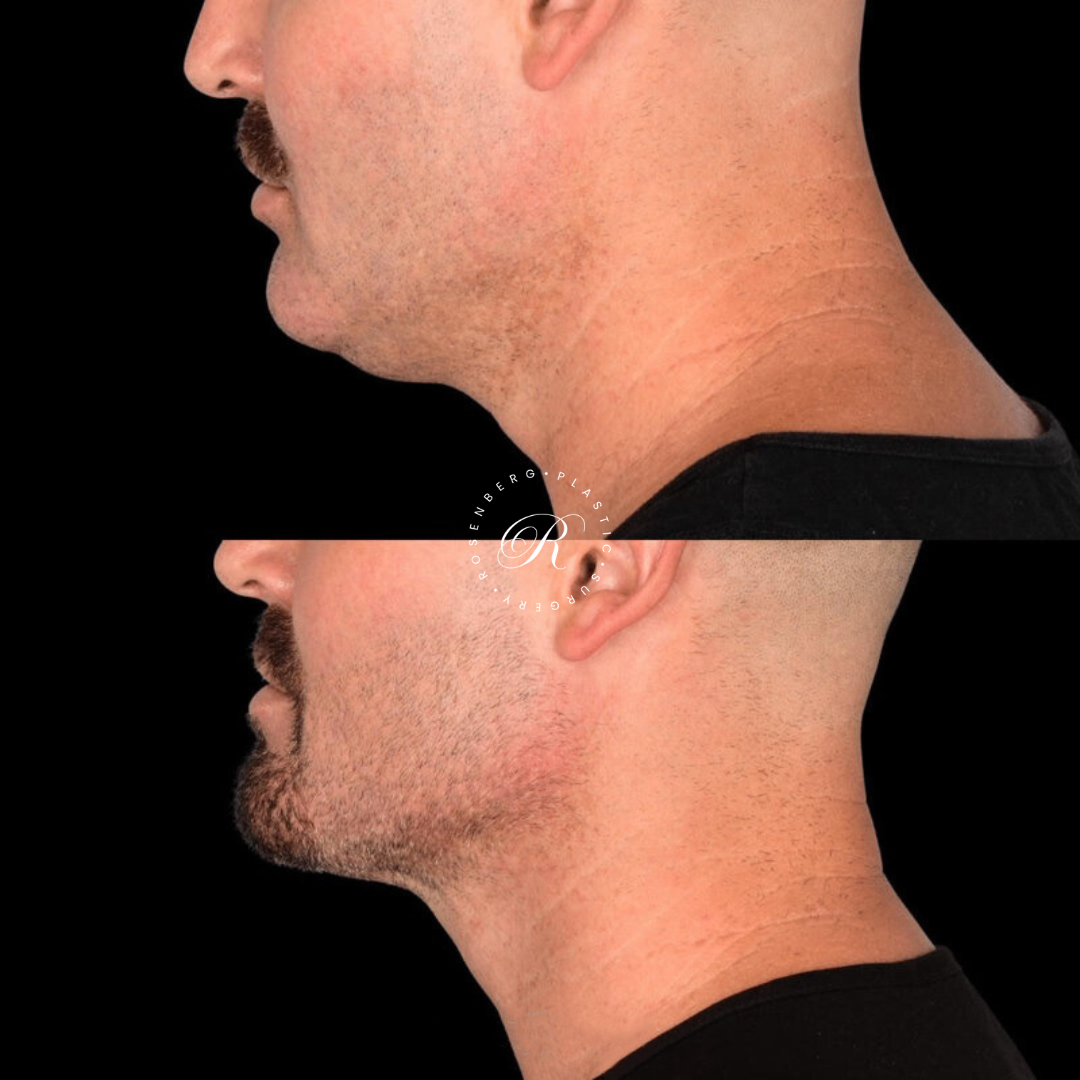 Neck Lipo RPS Before & After.zip - 28