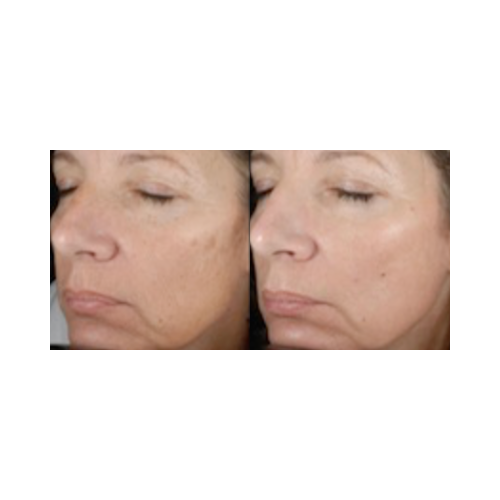 Before and after facial skin resurfacing using UltraLight CO₂ fractional laser