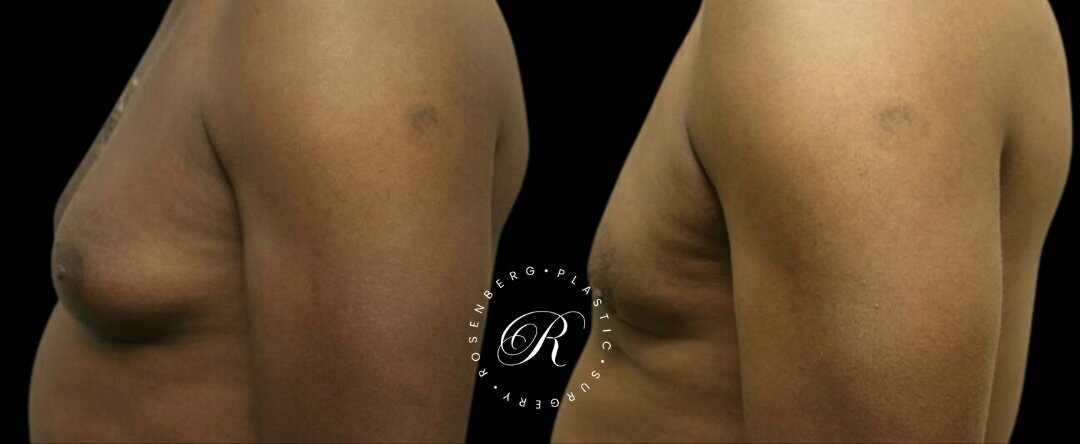 Gynecomastia RPS Before & Afters.zip - 6