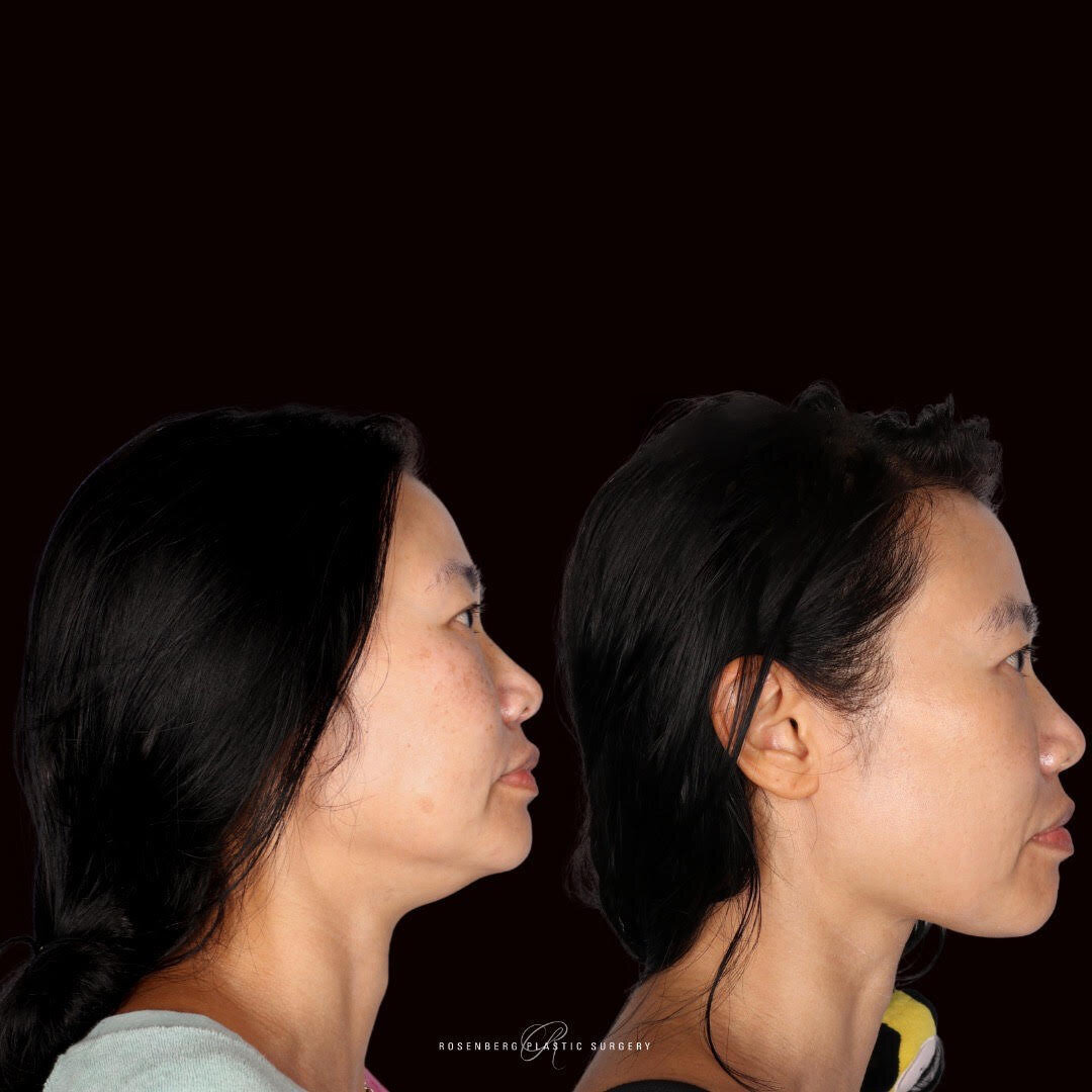 Picosure Hyperpigmentation