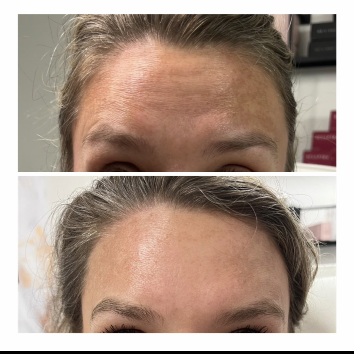 W Aesthetics Botox Before and After. Austin Texas12