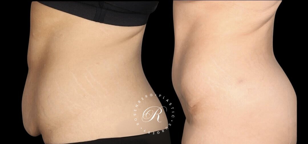 Abdominoplasty RPS Before & After.zip - 10