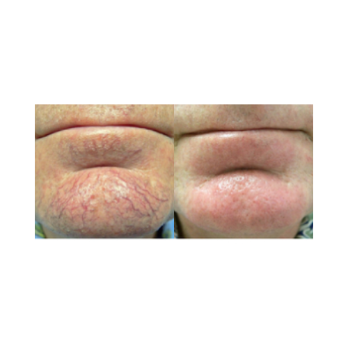 Before and after vascular lesion treatment using DermaLight KTP laser